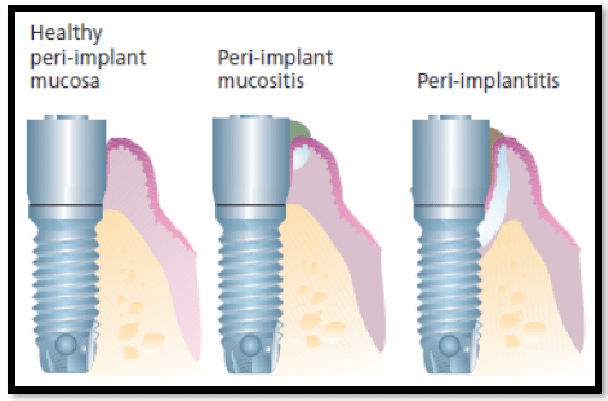 Peri-implantitis. Periodontal Disease with Implants - ARTEDENTAL